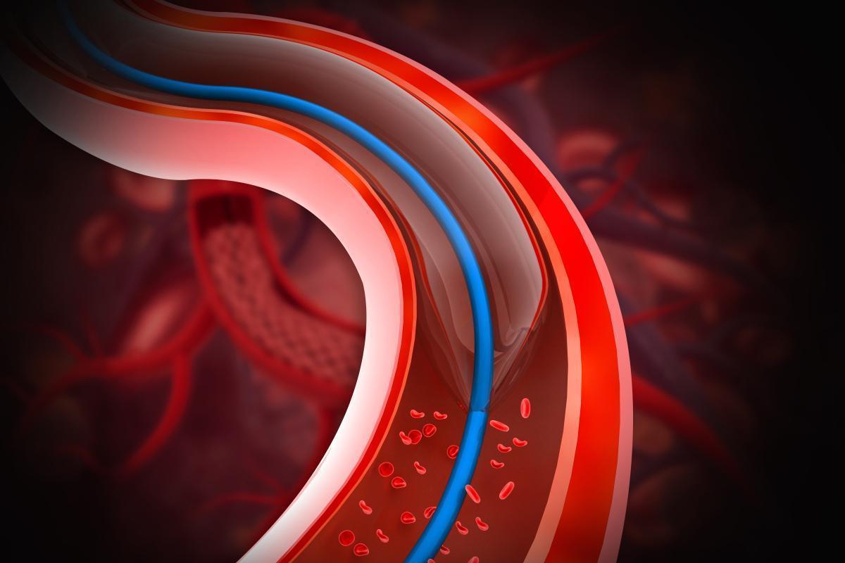  血型与凝血密码：60万人研究深度拆解A型血早发性中风机制 健康养生