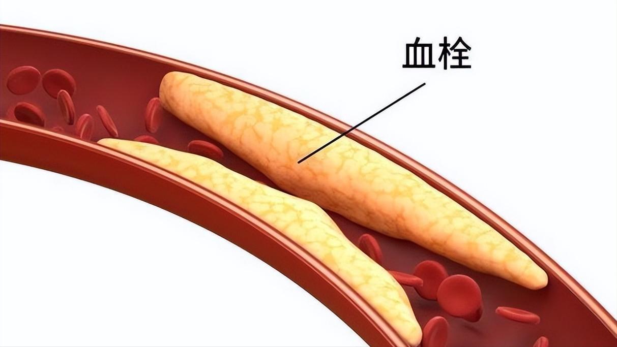  血型与凝血密码：60万人研究深度拆解A型血早发性中风机制 健康养生